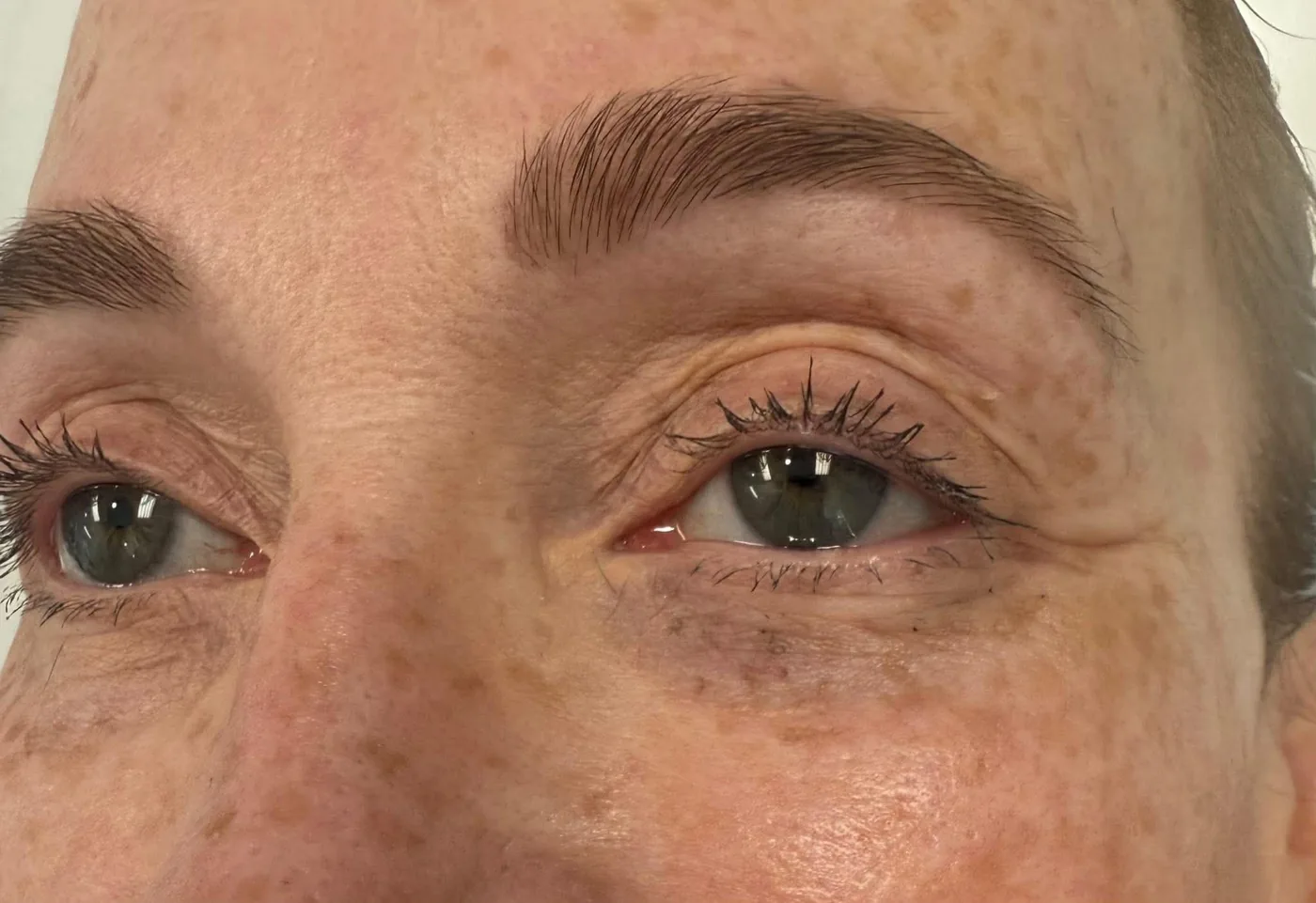 Skin treatment results